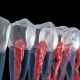 Root Canal Victorville, CA